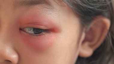 Kahverengi gözlü, saplı enfeksiyonlu Asyalı kadın çocuğu yakından çek. Göz kapağı apsesi, tıbbi sağlık, hastalık ve tedavi konsepti hordeolum