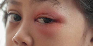 Kahverengi gözlü, saplı enfeksiyonlu Asyalı kadın çocuğu yakından çek. Göz kapağı apsesi, tıbbi sağlık, hastalık ve tedavi konsepti hordeolum