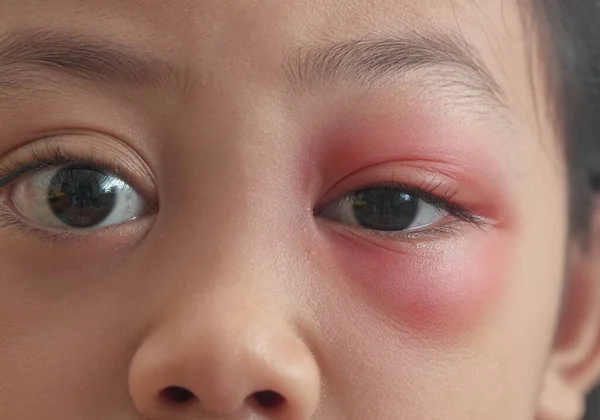 近视的亚洲女孩与褐色的眼睛与风格感染 眼睑脓肿 医学健康 疾病和治疗观念中的马氏菌病 — 图库照片