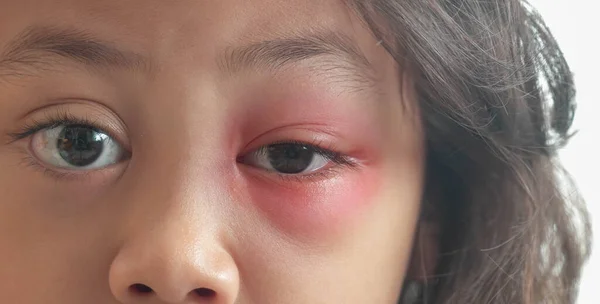 stock image Close up of Asian female kid with brown eye with stye infection. Eyelid abscess, hordeolum in medical health, disease and treatment concept