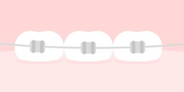 Diş telleri. Ortodonti kavramı. Yatay format. Vektör illüstrasyonu, düz tasarım
