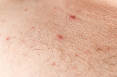 İnsan derisinde kırmızı sivilcelerin makro aşısı, sivilce hastalığı, dermatoloji sorunu..