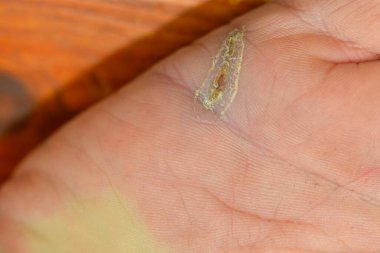 Elde yara iyileşiyor. Eldeki yaralar ve yaranın iyileşmesi. Sağlık ve öz bakım kavramı.