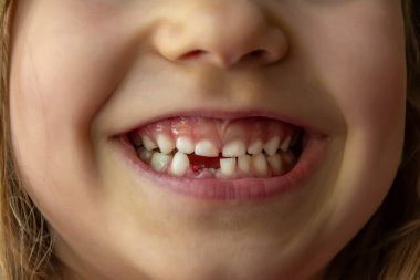  Ön dişi eksik, gülümseyen bir kızın yakın çekimi. Bir çocuğun bir dişi eksik ve birkaç diş daha gevşemiş. Tipik bebek dişi dökülme aşamaları ve kalıcı dişlerin büyümesi..