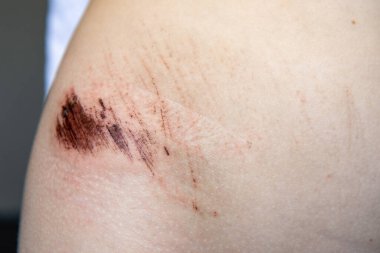 Çocuğun cildindeki yaraya yakın çekim, cilt ağrısı, hasta