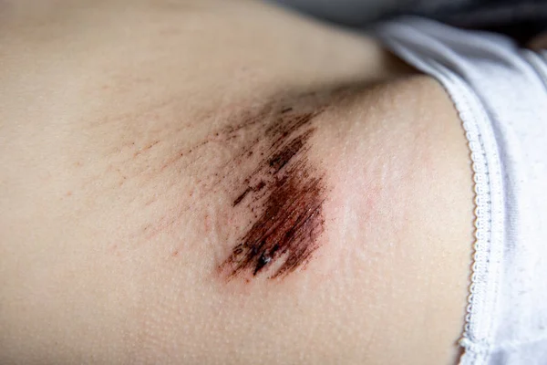 近距离观察儿童皮肤上的伤口 皮肤疼痛 — 图库照片