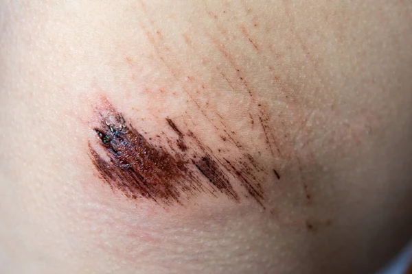 Κοντινό Πλάνο Μιας Πληγής Στο Δέρμα Του Παιδιού Πόνος Στο — Φωτογραφία Αρχείου