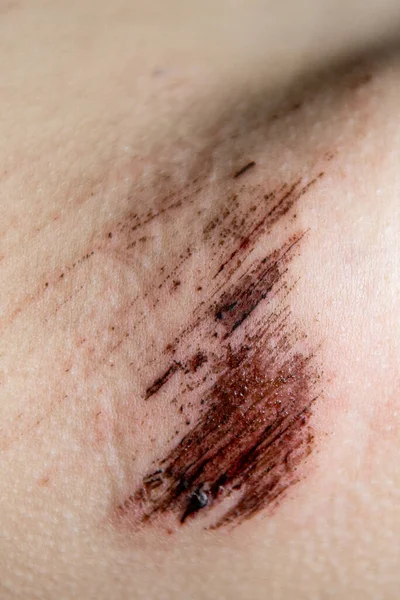 近距离观察儿童皮肤上的伤口 皮肤疼痛 — 图库照片