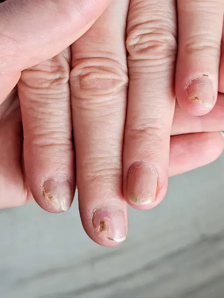 Hands and fingers with psoriatic onychodystrophy or psoriatic nails. fungal infection of nails. Deformed human nails. Damaged yellow human nail. Burn to the nail plate after a poor-quality manicure