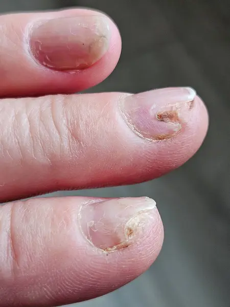 Hands and fingers with psoriatic onychodystrophy or psoriatic nails. fungal infection of nails. Deformed human nails. Damaged yellow human nail. Burn to the nail plate after a poor-quality manicure