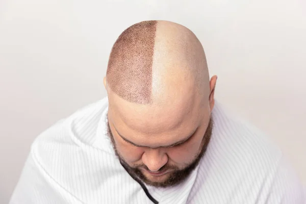 male baldness before and after treatment. portrait of a man with baldness problem at a hair transplant operation. Cosmetic surgery. the process of hair transplantation on the head.