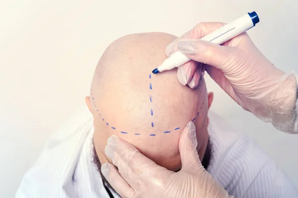 a nurse draws stripes on the bald skull of a young man for brain surgery. The concept of surgery and medicine.. the process of hair transplantation on the head. treatment of baldness.