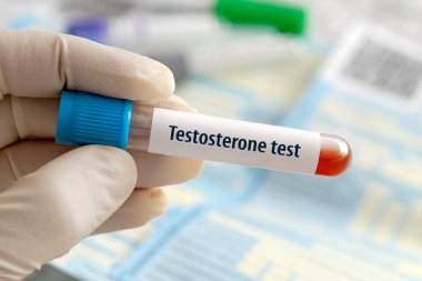 Testosteron hormon testi, mavi bir laboratuvar arka planında doktor eli üzerinde test tüpündeki kan örneğiyle sonuçlanır..