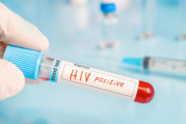 Diagnosticista Che Tiene Mano Test Hiv Positivo Uno Sfondo Laboratorio — Foto Stock