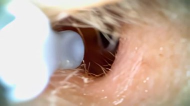 Tıbbi otoskop, kulak kiri ve ince kıllarla bir kulak kanalının yakın görüntüsünü sağlayarak potansiyel kulak sağlığı sorunlarını vurguluyor.