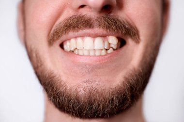 Genç adam gösterilen dişler büyüyen yamuk. Adam diş telleri yüklemek için Dişçiye gitmesi gerekiyor.