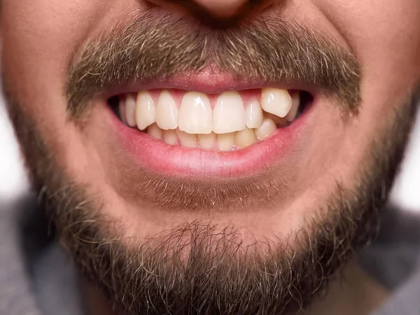 Young man showing crooked growing teeth. The man needs to go to the dentist to install braces.
