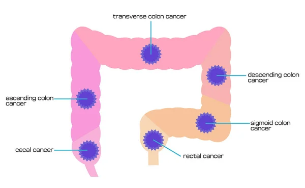 Εικονογραφημένοι Τύποι Καρκίνου Του Παχέος Εντέρου Ανά Θέση — Διανυσματικό Αρχείο