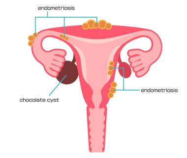 Illustrated types of gynecological diseases, endometriosis clipart