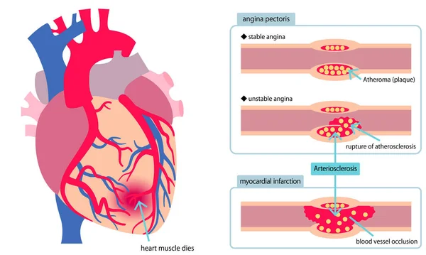 Illustrierte Darstellung Von Herzkrankheiten — Stockvektor