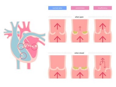 Kalp kapakçığı hastalığı diyagramı