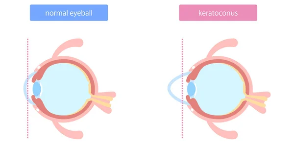 Göz küresi anormalliği, keratoconus çizimi