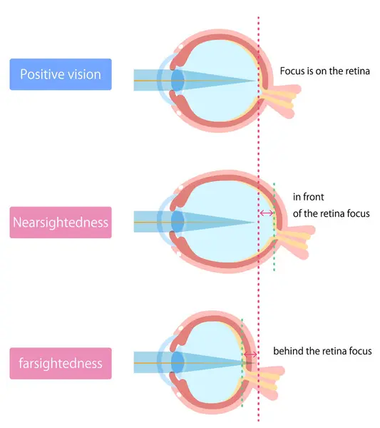 Emmetropia, miyopluk ve hipermetropluk arasındaki farkın resmi.