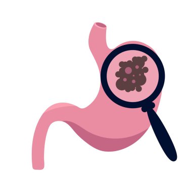 Mide kanserinin resimsel görüntüsü