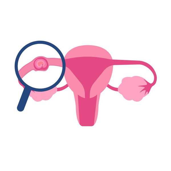 Иллюстративный образ внематочной беременности