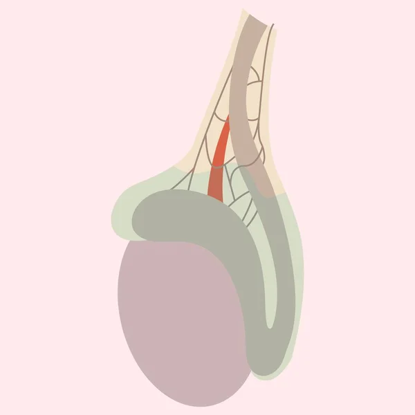 stock vector Illustration of a hydrocele, a common medical condition that affects the male reproductive system. Ideal for medical textbooks or websites.