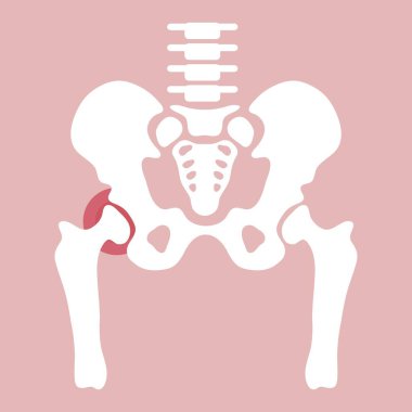 Kalça Artrit düz illüstrasyon vektörü