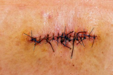 Sırtında apse ameliyatının çift dikiş izi var.