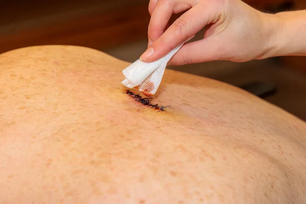 A hand cleans a double sutured scar from abscess surgery on a back with iodine and a swab