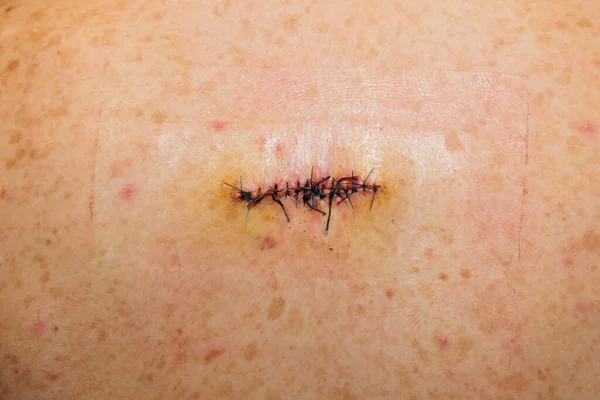 Double Sutured Scar Abscess Surgery Back — Stock Photo, Image