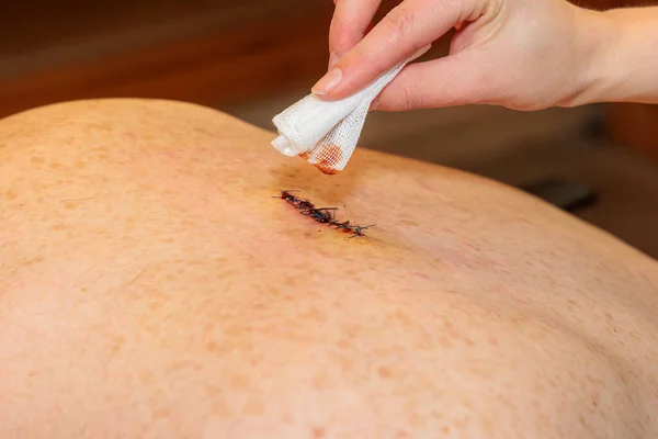 Hand Cleans Double Sutured Scar Abscess Surgery Back Iodine Swab — Stock Photo, Image