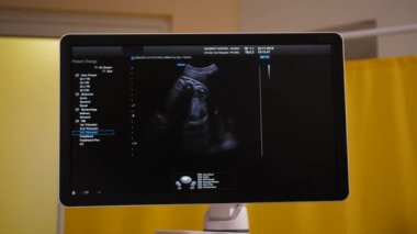 Sonen ile ultrason ekranı. Klinikte ultrason için ultrason. tıbbi geçmiş