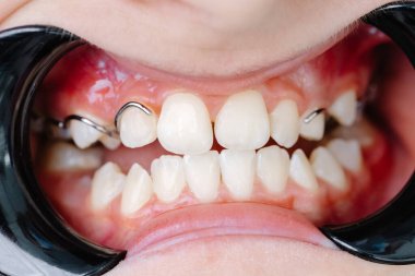 Ortodontik cihaz diş hizasını usulca düzeltiyor, diş bakımını gösteriyor ve mükemmel bir gülümseme elde etme süreci