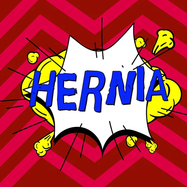Sign displaying Hernia, Word for Abnormal exit of tissue or an organ through the wall of the cavity