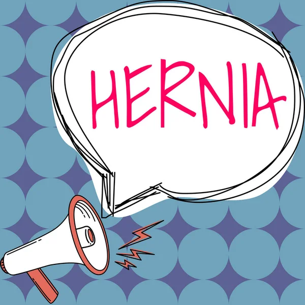Handwriting text Hernia, Word for Abnormal exit of tissue or an organ through the wall of the cavity