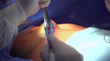 Cerrahi göğüs büyütme. Göğüs implantı yerleştirilmiş. Göğüs büyütme ameliyatı..