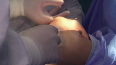 Cerrahi göğüs büyütme. Göğüs implantı yerleştirilmiş. Göğüs büyütme ameliyatı..