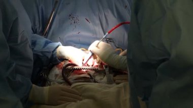 Açık kalp ameliyatı. Kalp ameliyatı. Bir donörden kalp nakli. 