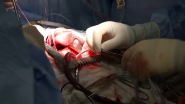 Açık kalp ameliyatı. Kalp ameliyatı. Bir donörden kalp nakli. 