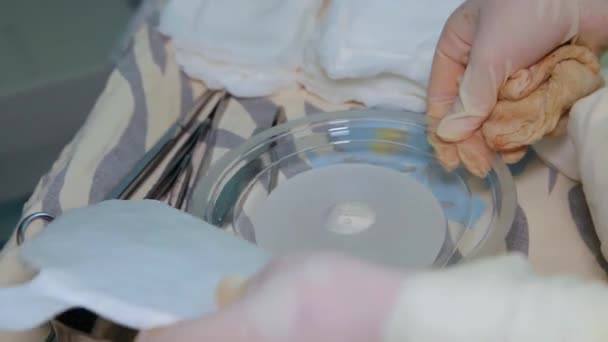Implante Mamário Remoção Tumor Maligno Glândula Mamária Instalação Implante Mamário — Vídeo de Stock