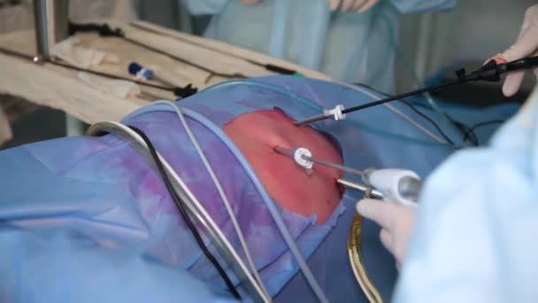 Хірурги Тримають Руки Під Час Лапароскопічної Операції Животі Робота Використанням — стокове відео