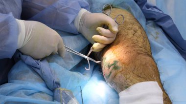 Büyük safenöz damarın endovenöz lazer fotokopisi için tıbbi ameliyat. Minifilejektomi. Endovenöz lazer pıhtılaşma damarı.