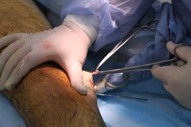 Büyük safenöz damarın endovenöz lazer fotokopisi için tıbbi ameliyat. Minifilejektomi. Endovenöz lazer pıhtılaşma damarı.