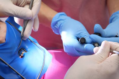 Diş hekimliği. Fotoğraf doldurma. Diş fotografı. Dişçinin işyeri. Bir dişi ultraviyole ışıkla doldurmak.