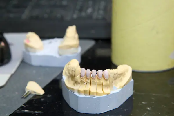 Fabrication of dental crowns and dentures made of ceramic. Scanning of plaster casts of teeth. Fabrication of ceramic dentures in a dental clinic. Ceramic dental crowns for implants.