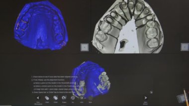 Takma diş üretimi için 3 boyutlu tarayıcıdaki kalıpların taranması. Diş kliniğinde seramik protez üretimi. İmplantlar için seramik diş başlıkları.